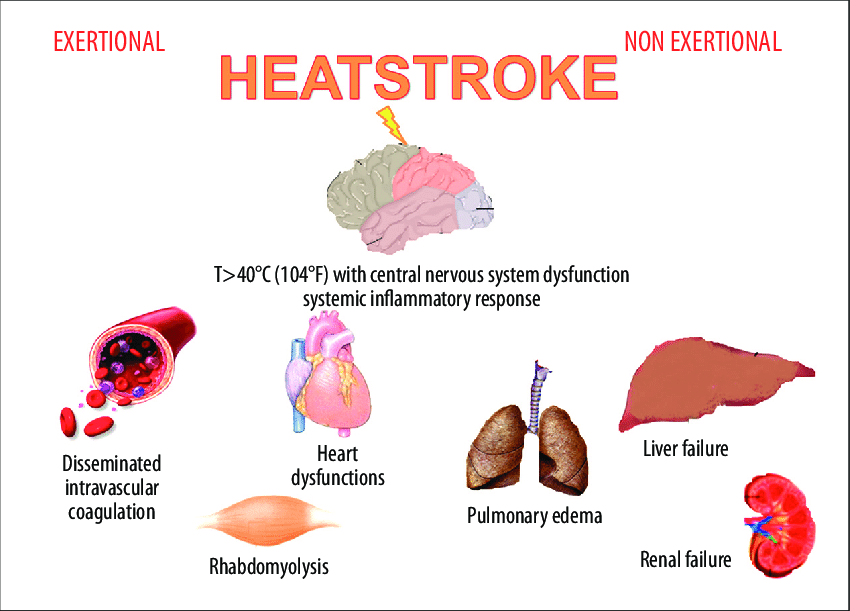 Exertional Heat Stroke and Sudden Death